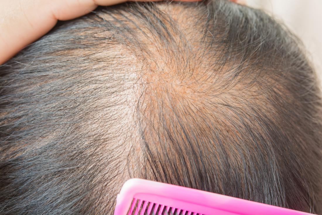 Popular Hair loss treatment Procedures in Lahore, Best hair Specialist in Lahore, hair clinic in lahore, doctor for hair loss, best treatment for hair loss