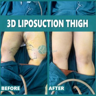 Best Liposuction Treatment For Legs in Lahore, Pakistan