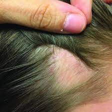 Best hair Specialist in Lahore, hair clinic in lahore, doctor for hair loss, best treatment for hair loss