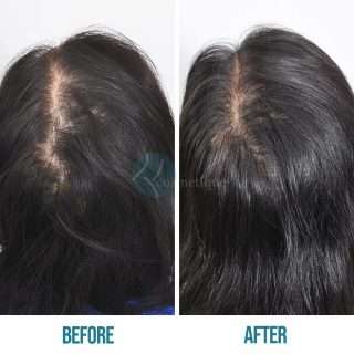 Best hair Specialist in Lahore, hair clinic in lahore, doctor for hair loss, best treatment for hair loss