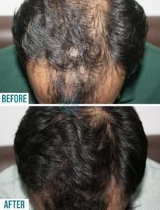 Best hair Specialist in Lahore, hair clinic in lahore, doctor for hair loss, best treatment for hair loss