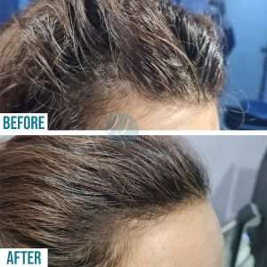 Best hair Specialist in Lahore, hair clinic in lahore, doctor for hair loss, best treatment for hair loss