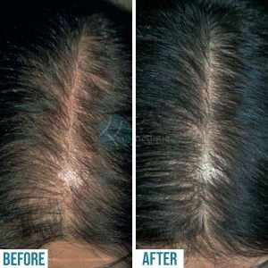 Best hair Specialist in Lahore, hair clinic in lahore, doctor for hair loss, best treatment for hair loss